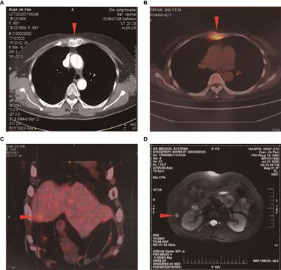 Case Report: Molecular Profiling Assists in the Diagnosis and Treatment of Cancer of Unknown Primary